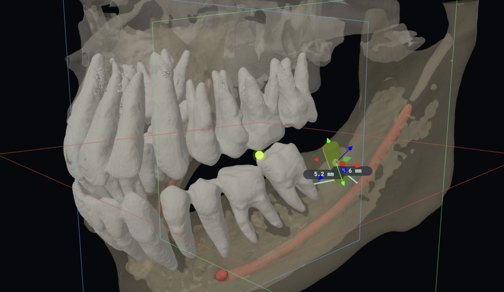 3D Implant Planning
